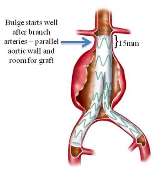 Aortic pajama graft