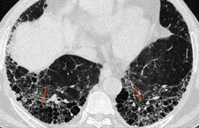 Approach to interstitial lung disease: Dr Bhavin Jankharia’s talk ...