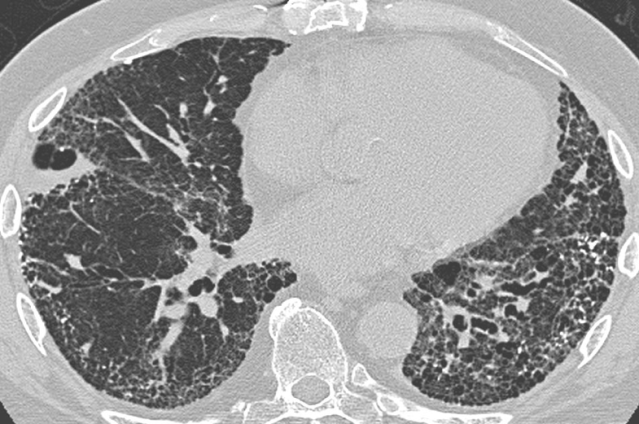 Possible Uip Pattern Approach to interstitial lung disease: Dr Bhavin Jankharia’s talk ...