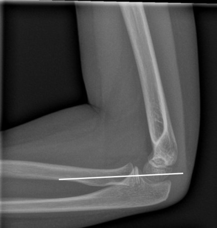 Radiocapitellar line1