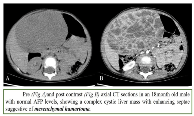 Mesenchymal hamartoma