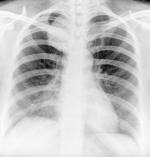 CT Sign CXR