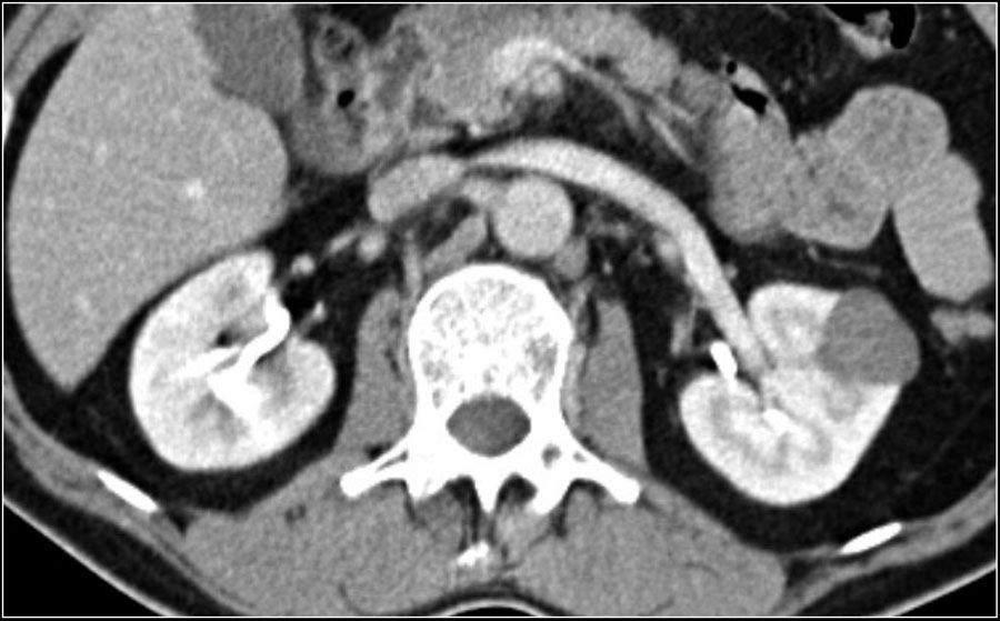Renal Rcc Radiopaedia Approach to renal lesions: Dr Veena Iyer’s talk – Cafe Roentgen