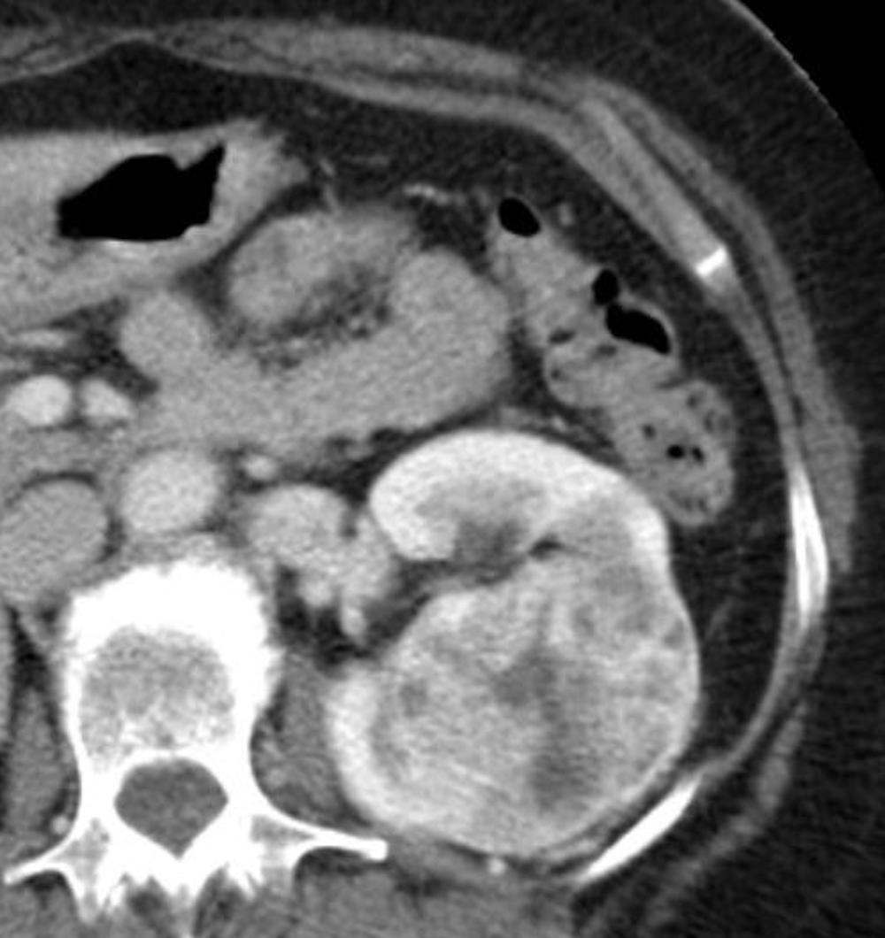 Renal Rcc Radiopaedia Approach to renal lesions: Dr Veena Iyer’s talk – Cafe Roentgen