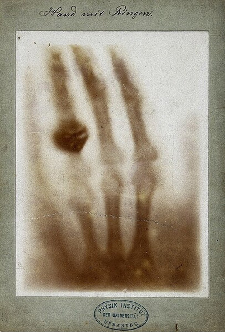 A Tale of Two Hands: The Story behind the Two Famous Radiographs ...