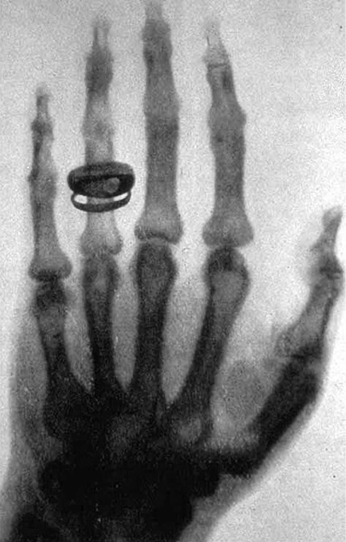 A Tale of Two Hands: The Story behind the Two Famous Radiographs ...